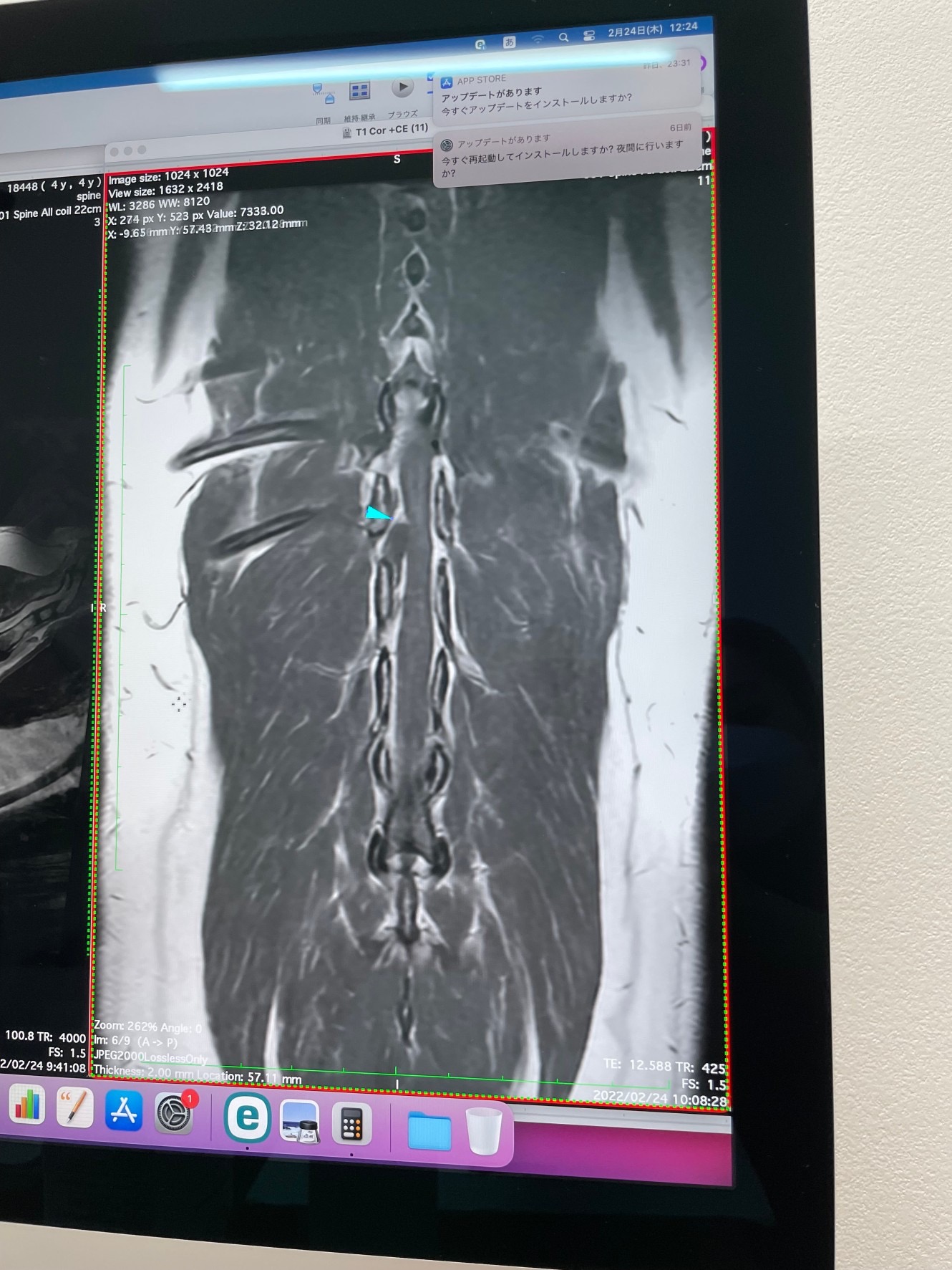 椎間板ヘルニア（MRI)。水色の矢印部分。